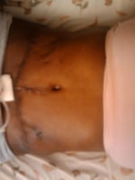 Scar 10 days post-op