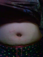 after surgery but this is how it look when i sit down and this is the part i dont like