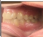 Start of treatment