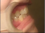 Start of treatment