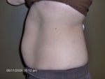 Side shot before lipodissolve