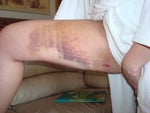 burn on inner thigh