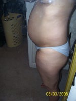The day before surgery 
