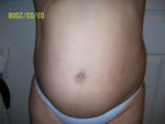 The day before surgery
