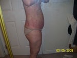 1 day after surgery