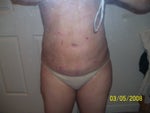 1 day after surgery