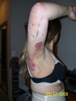 2 days after arm surgery
