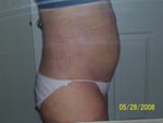 3 months after surgery