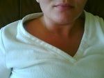 about 7 months after lip augmentation