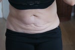 The day before surgery leaning over slightly to see excess skin.