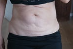 The day before surgery my tummy is a mess!