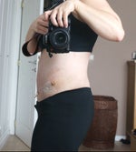 One week post-op side view. 