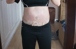 One week post-op still with tape and tubes, but no extra fat or skin!