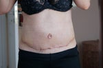 Two week post-op front view (no more tubes!)