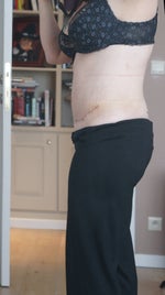 Two weeks post-op side view