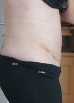Two weeks post-op side view closeup