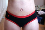 Three weeks post-op