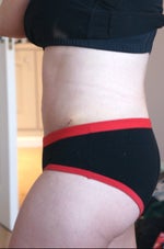 Three weeks post-op