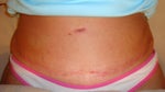 This is my scar at 8 weeks.
