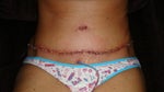 This a few days after surgery.