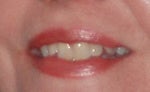 Before Invisalign
