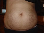 BEFORE Smartlipo MDX