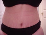 11 days after - Type 1 Diabetic