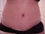 11 days after - Type 1 Diabetic