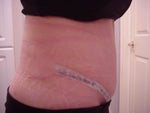 11 days after - Type 1 Diabetic