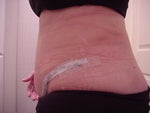 11 days after - Type 1 Diabetic