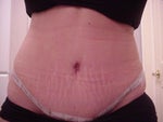 11 days after - Type 1 Diabetic