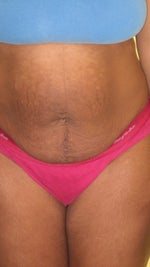 Pre-op pics