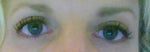 after eyelid surgery 2 mos, still a little puffiness in left eyelid