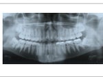 Crazy Impacted Molars