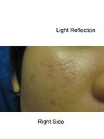 lots of acne scar and redness!! :(