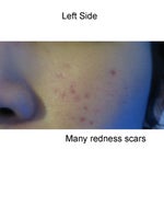 Acne scar and redness!!!!