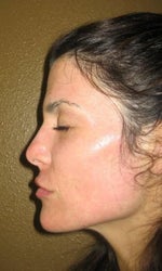 Day 11 - can see the blotchiness and redness