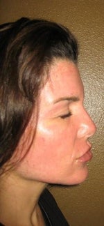 Day 6- all shedding gone... Broken capillary on cheek where skin got too dry