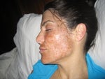 The day of procedure at home