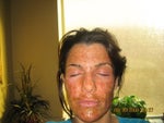 Day after procedure- day 1