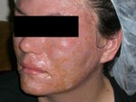 This is right after the procedure. Ouch!!!!!!!!!!!!!!!!!!