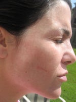 Day 24... look around forehead for "honeycomb" texture... stripes on cheeks.. (Scar from son scratching)