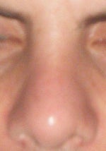 5 weeks after (Front view)