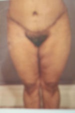 After (3 months post surgery)