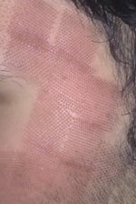 Left side after fraxel. look to the brown place deep burn