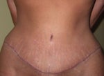 7 weeks after tummy tuck surgery