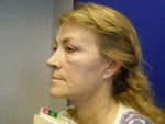 After, check out the extra smile line not there before and the extra lines around my mouth -- ALSO not there before!
