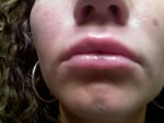 right after the injections.. red and swollen