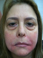 This is after the initial 1 1/2 vials...red and swelling went away in 5 days