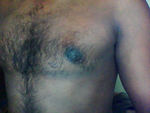 left niple, more puffy, scar like two skin joint, will this ever get filled that gap??